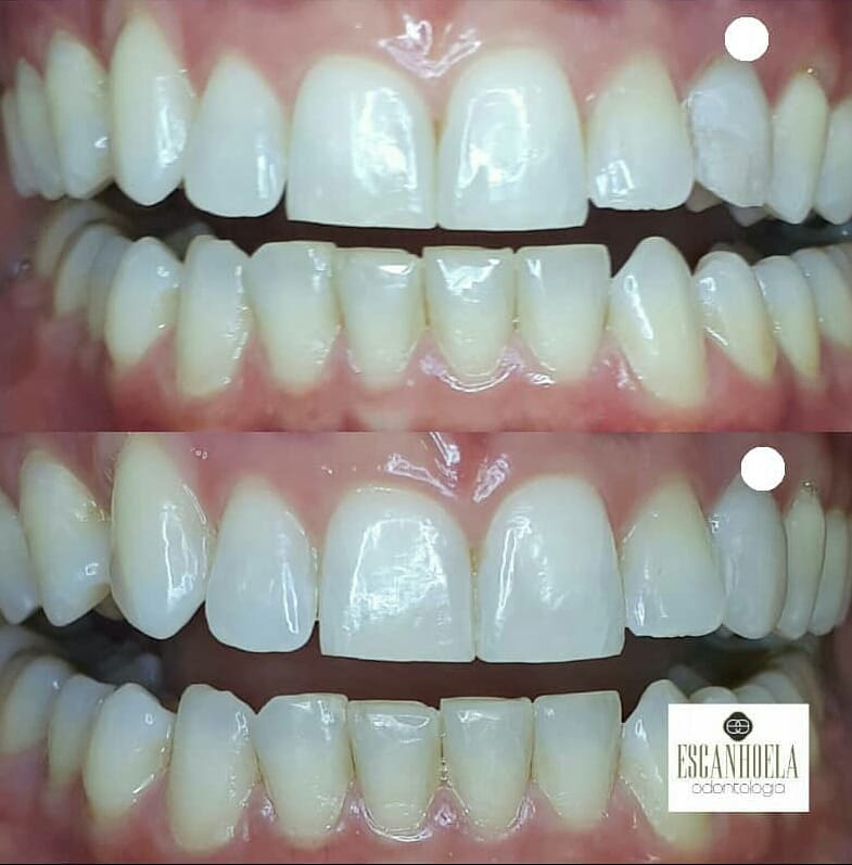 Restauração Estética — antes e depois